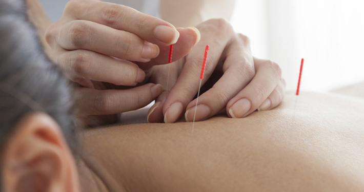 stock-photo-closeup-of-woman-receiving-acupuncture-treatment-at-beauty-spa-329803421